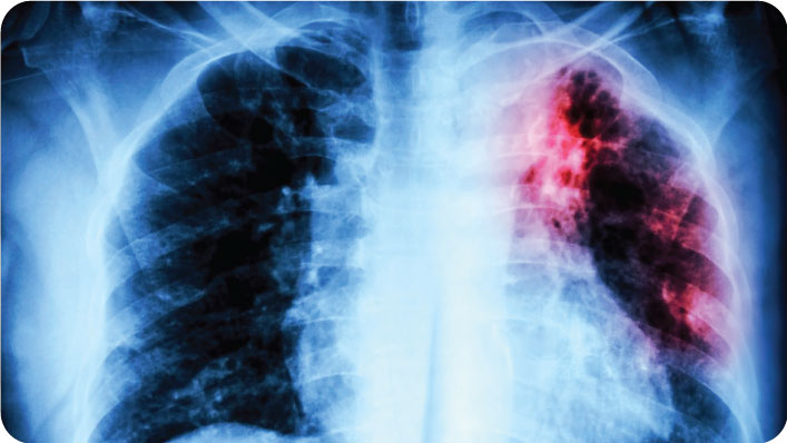 Lungs X-Ray
